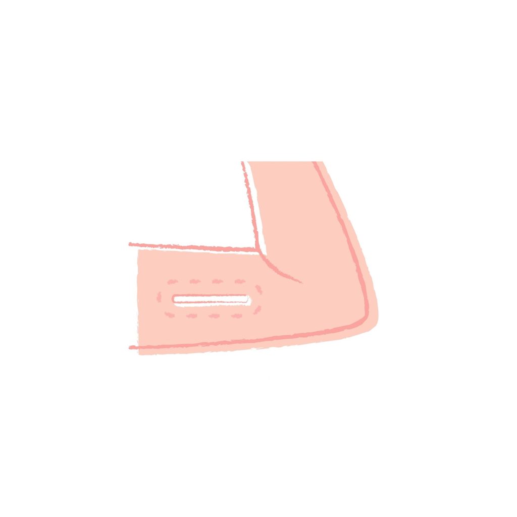 Contraceptive Implant Fittings
